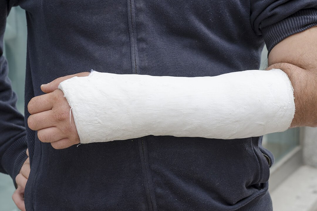arm in a plastercast
