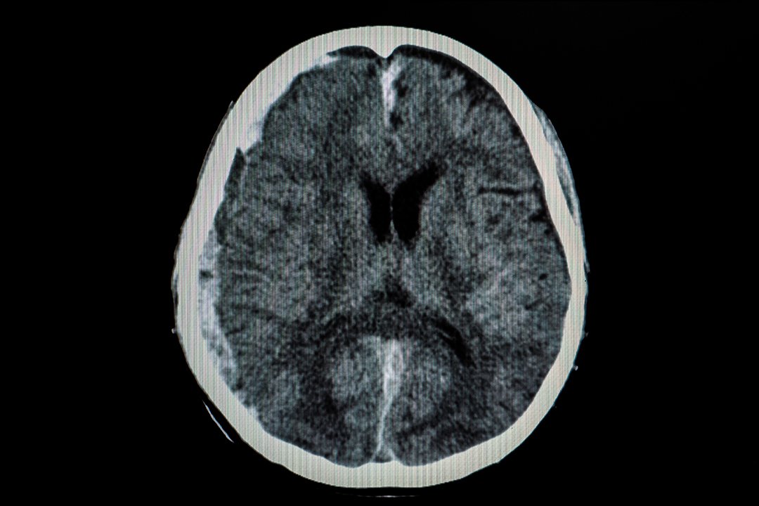 Gehirnödem - CT-Bild