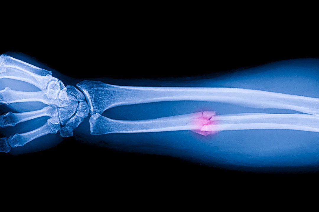 Fliegen mit Gips – geht das ohne Probleme?