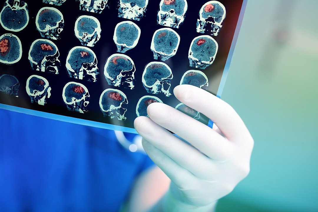 Röntgenbild des Gehirns