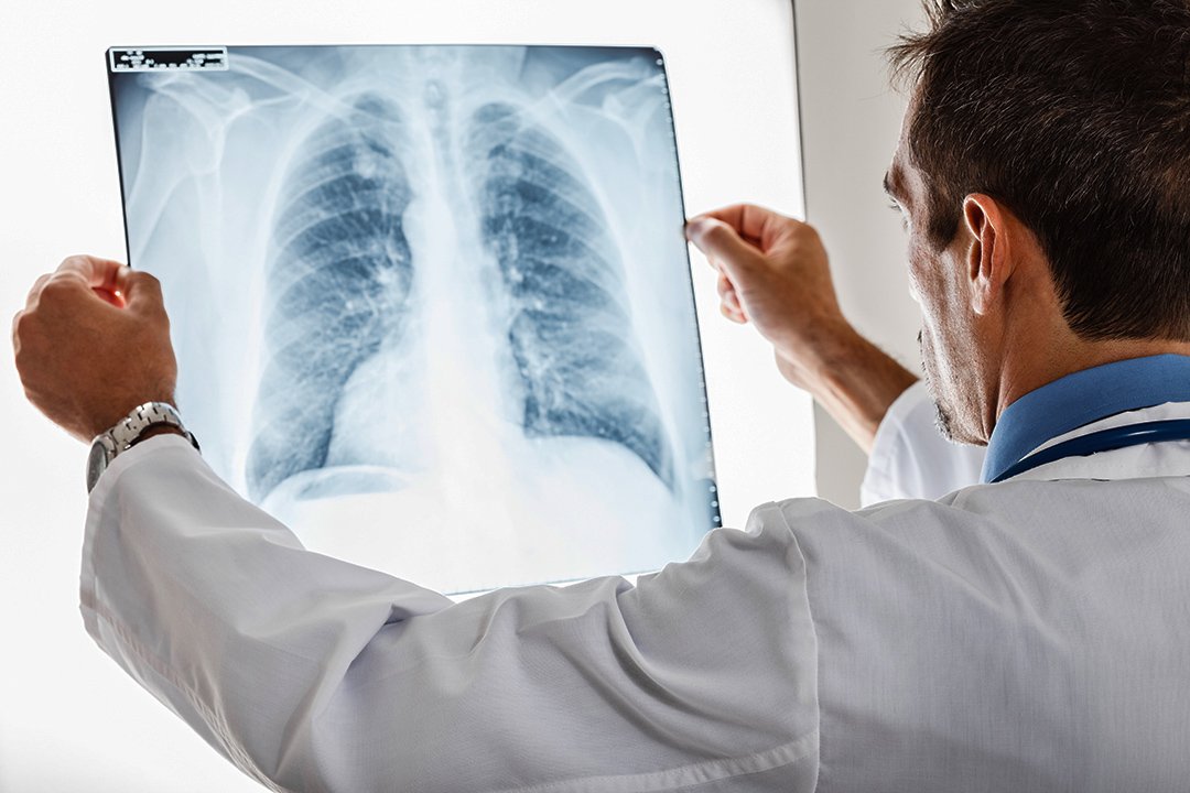 Arzt prüft Röntgenbild einer Lunge