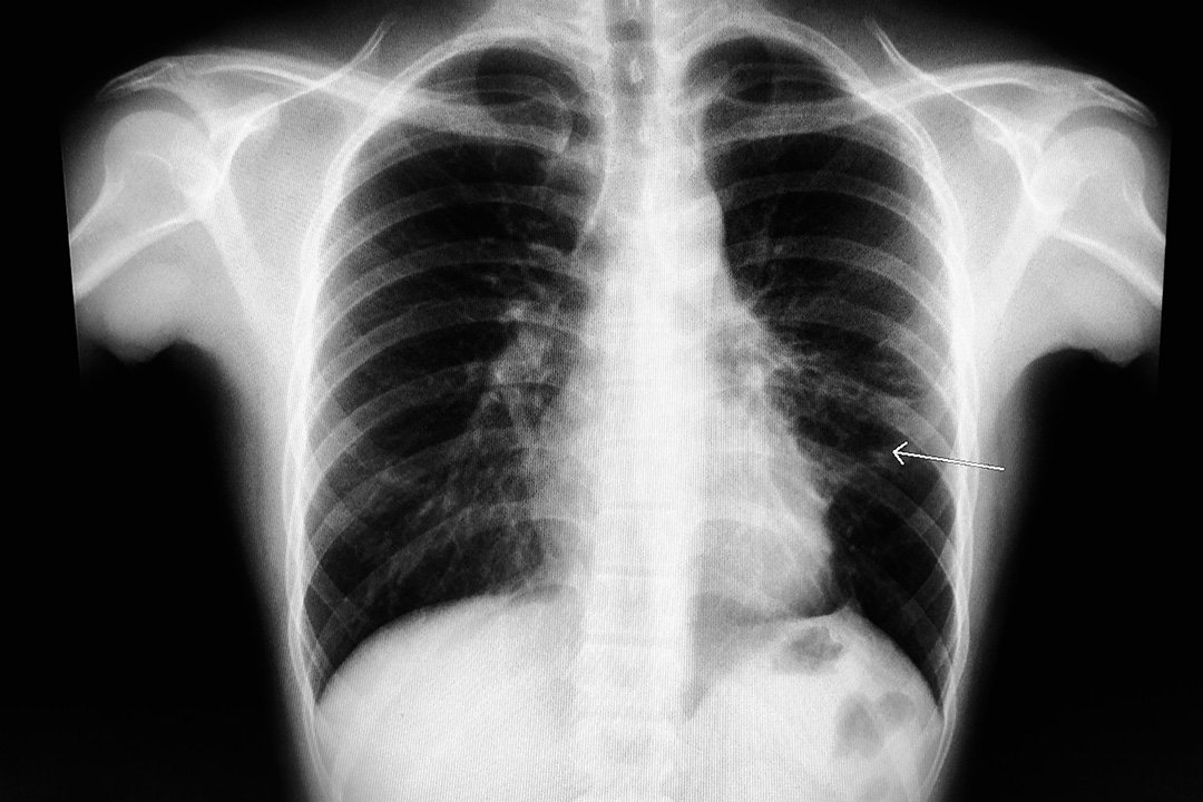 Röntgenbild Lungenfibrose